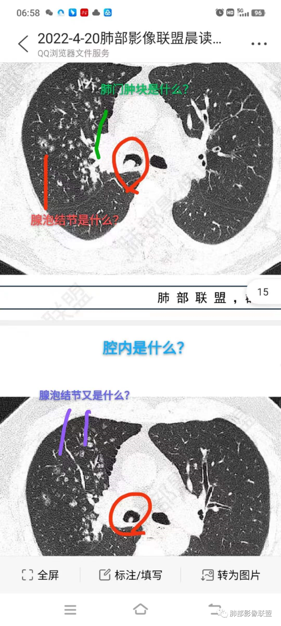 影像PPT - 【病例】支气管神经内分泌癌1例CT影像-37 影像PPT - 【病例】支气管神经内分泌癌1例CT影像-37