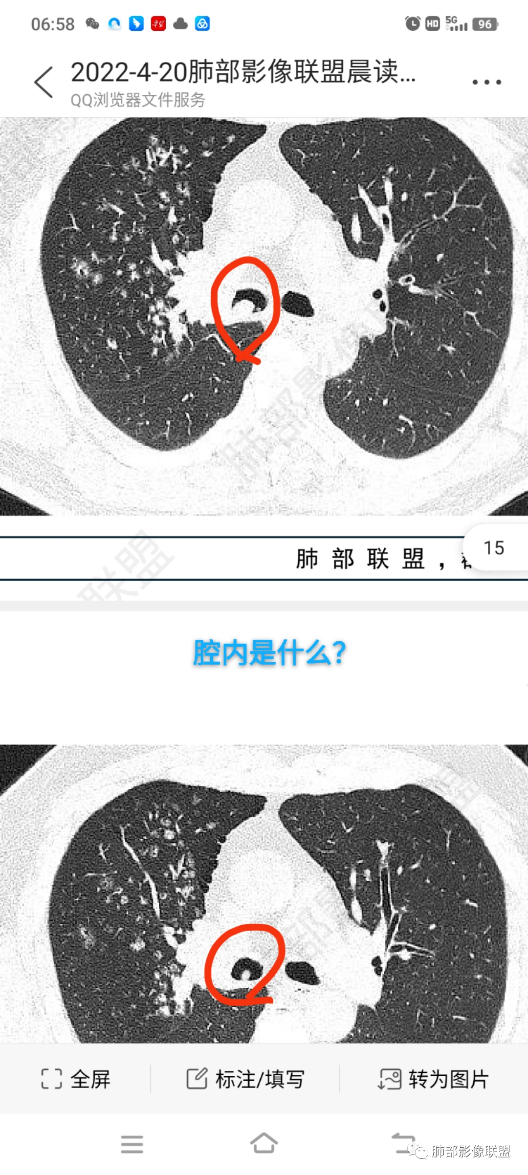影像PPT - 【病例】支气管神经内分泌癌1例CT影像-38 影像PPT - 【病例】支气管神经内分泌癌1例CT影像-38