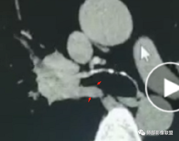 影像PPT - 【病例】支气管神经内分泌癌1例CT影像-43 影像PPT - 【病例】支气管神经内分泌癌1例CT影像-43