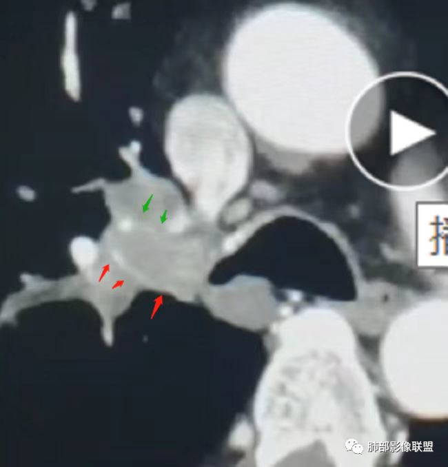 影像PPT - 【病例】支气管神经内分泌癌1例CT影像-45 影像PPT - 【病例】支气管神经内分泌癌1例CT影像-45