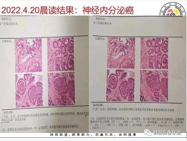 影像PPT - 【病例】支气管神经内分泌癌1例CT影像-46 影像PPT - 【病例】支气管神经内分泌癌1例CT影像-46