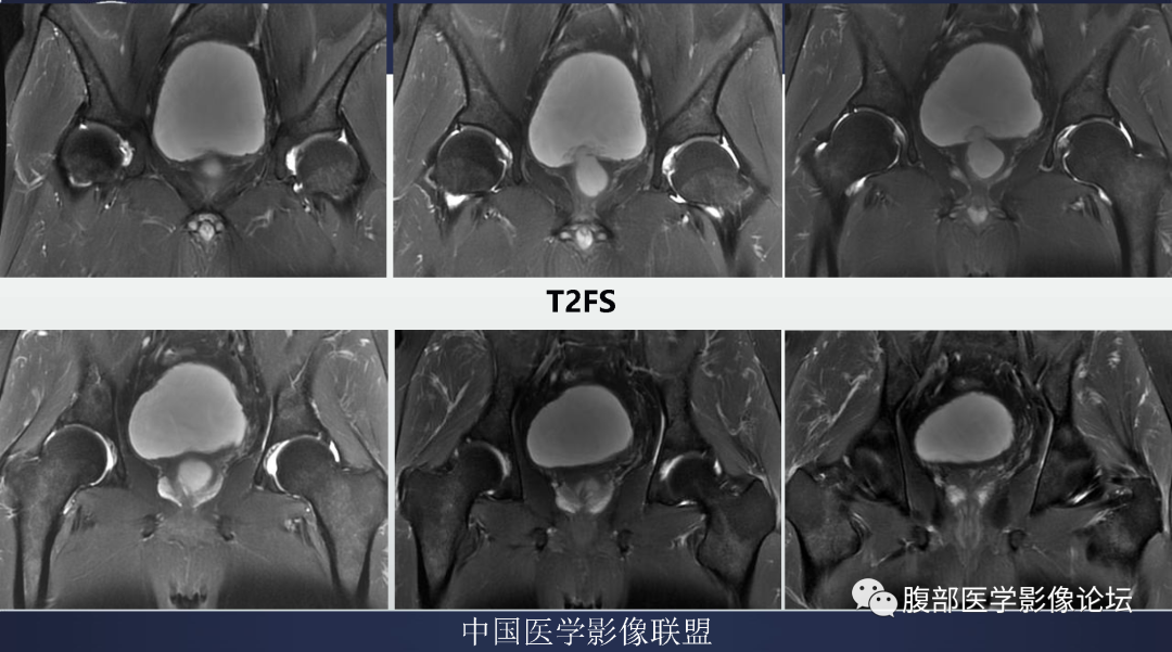影像PPT - 【病例】膀胱神经纤维瘤1例MR影像-7 影像PPT - 【病例】膀胱神经纤维瘤1例MR影像-7