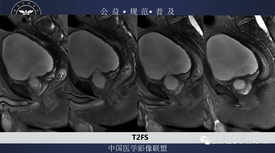 影像PPT - 【病例】膀胱神经纤维瘤1例MR影像-6 影像PPT - 【病例】膀胱神经纤维瘤1例MR影像-6