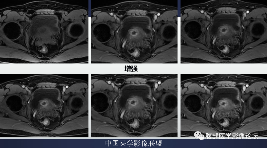 影像PPT - 【病例】膀胱神经纤维瘤1例MR影像-8 影像PPT - 【病例】膀胱神经纤维瘤1例MR影像-8