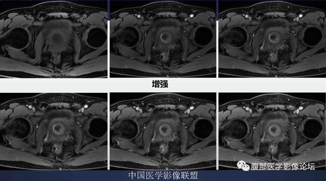 影像PPT - 【病例】膀胱神经纤维瘤1例MR影像-9 影像PPT - 【病例】膀胱神经纤维瘤1例MR影像-9
