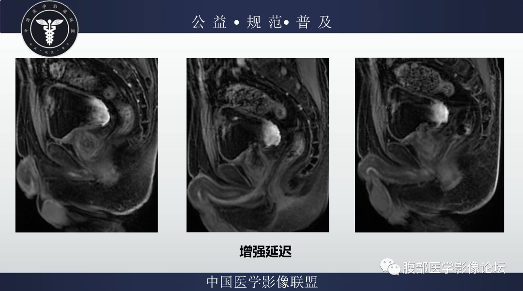 影像PPT - 【病例】膀胱神经纤维瘤1例MR影像-11 影像PPT - 【病例】膀胱神经纤维瘤1例MR影像-11