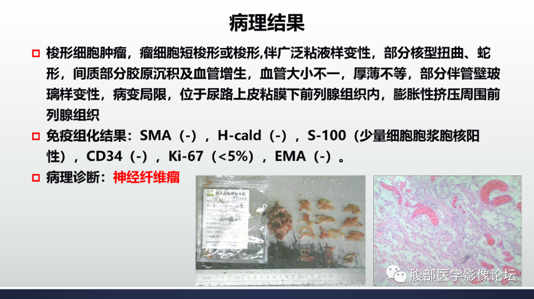 影像PPT - 【病例】膀胱神经纤维瘤1例MR影像-13 影像PPT - 【病例】膀胱神经纤维瘤1例MR影像-13