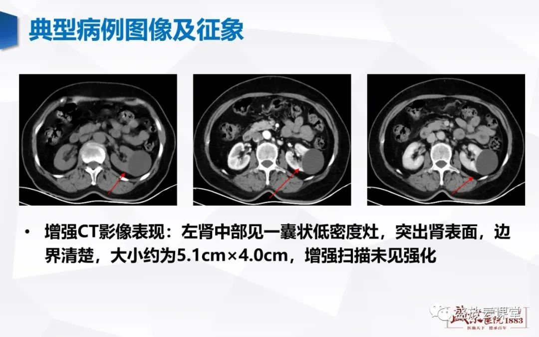 影像PPT - 【PPT】肾脏囊性病变-12 影像PPT - 【PPT】肾脏囊性病变-12