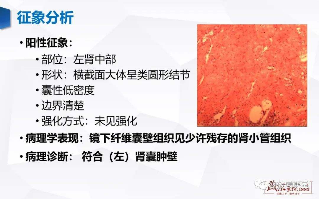 影像PPT - 【PPT】肾脏囊性病变-13 影像PPT - 【PPT】肾脏囊性病变-13