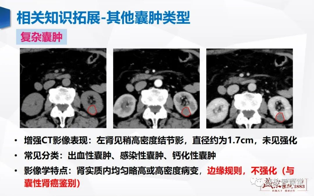 影像PPT - 【PPT】肾脏囊性病变-20 影像PPT - 【PPT】肾脏囊性病变-20
