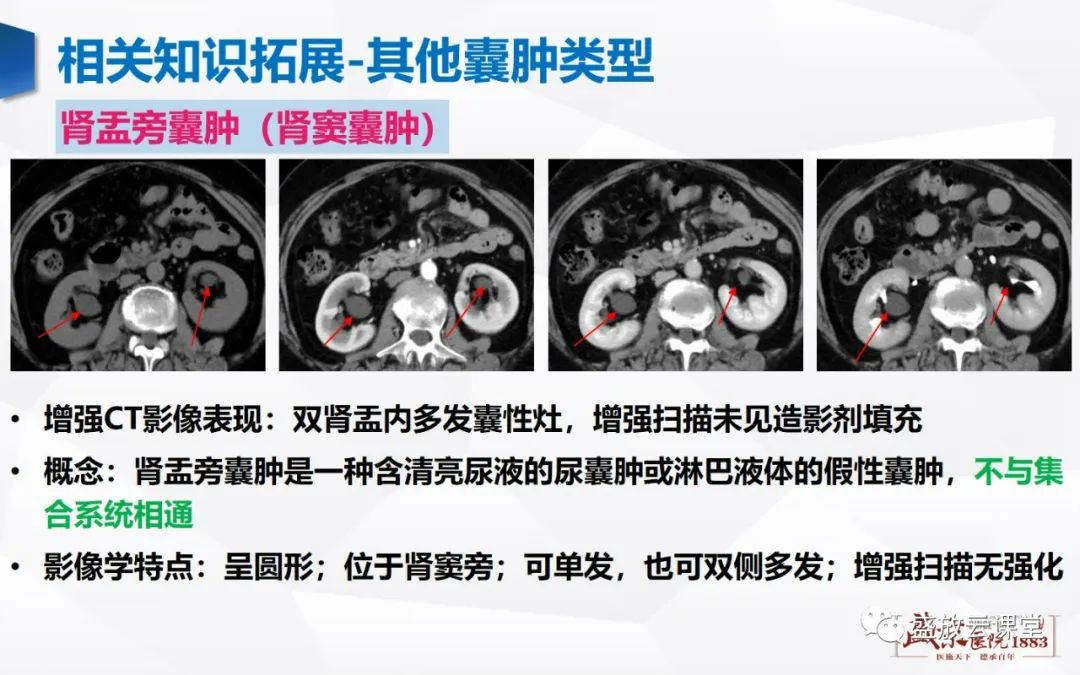 影像PPT - 【PPT】肾脏囊性病变-21 影像PPT - 【PPT】肾脏囊性病变-21