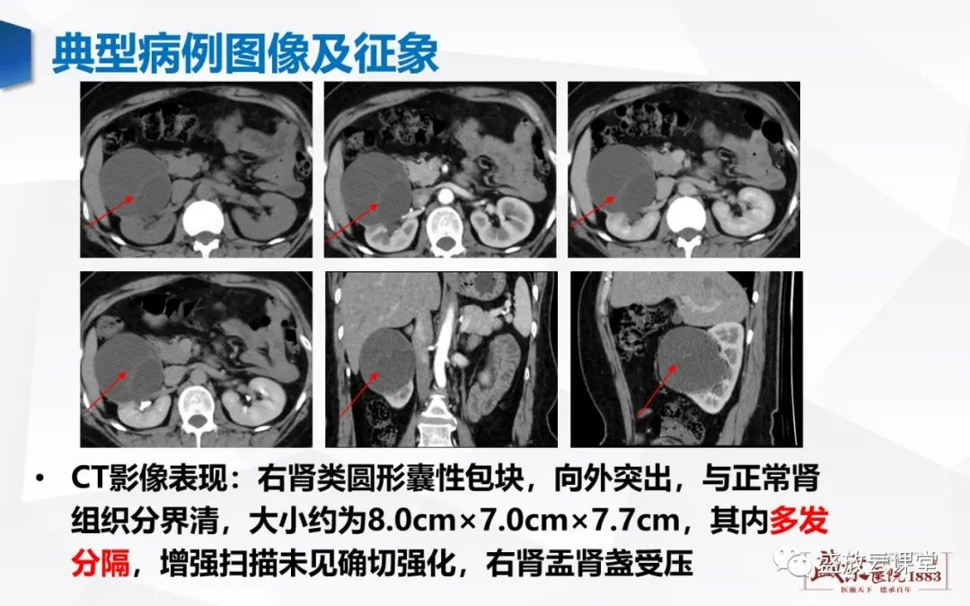 影像PPT - 【PPT】肾脏囊性病变-24 影像PPT - 【PPT】肾脏囊性病变-24
