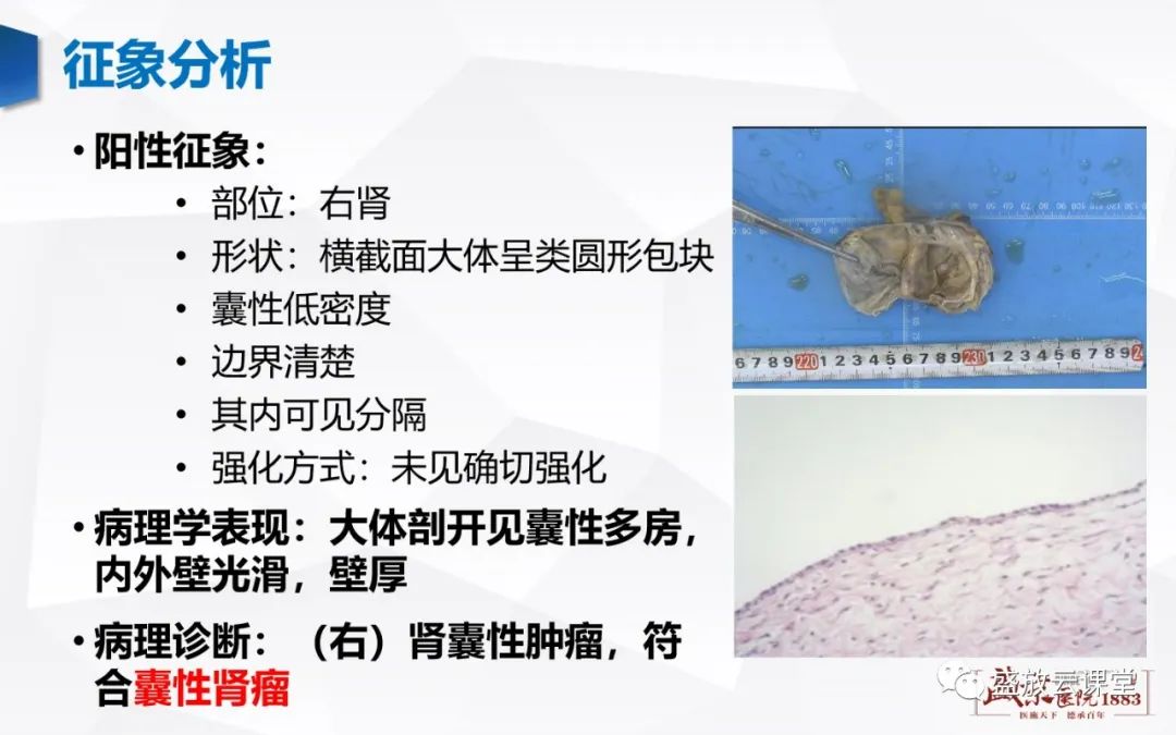 影像PPT - 【PPT】肾脏囊性病变-25 影像PPT - 【PPT】肾脏囊性病变-25