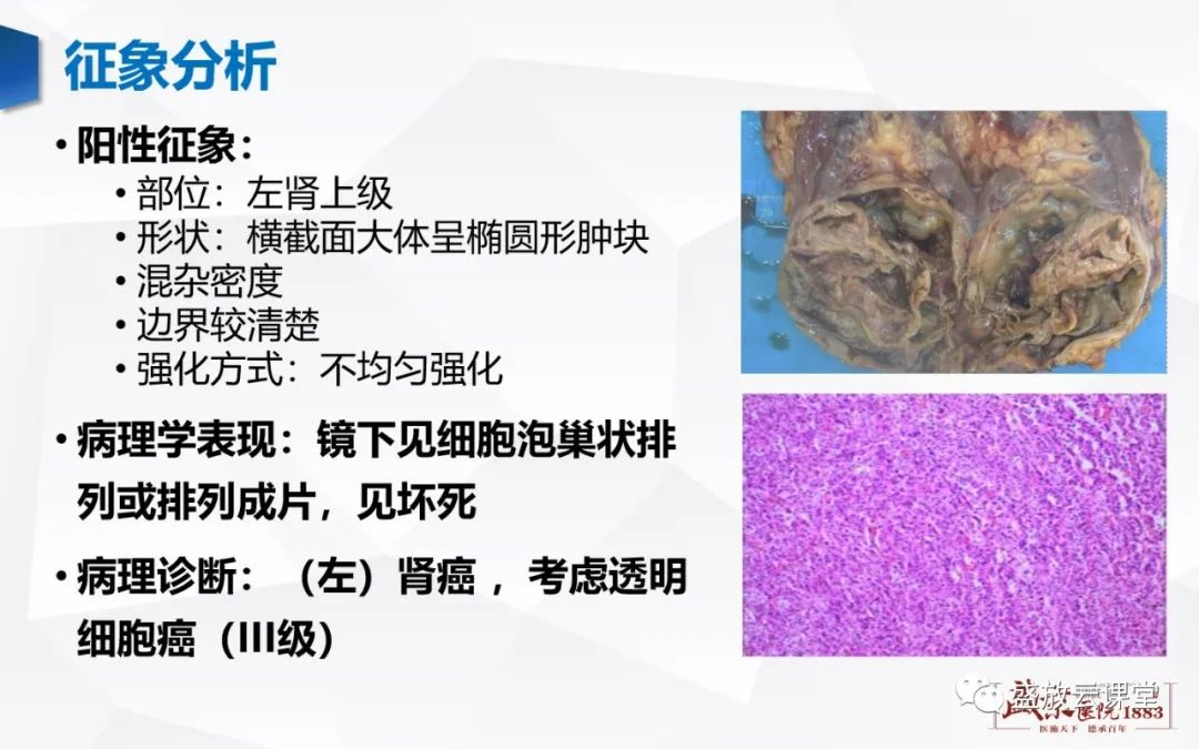 影像PPT - 【PPT】肾脏囊性病变-30 影像PPT - 【PPT】肾脏囊性病变-30
