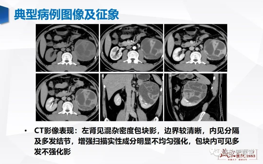 影像PPT - 【PPT】肾脏囊性病变-29 影像PPT - 【PPT】肾脏囊性病变-29