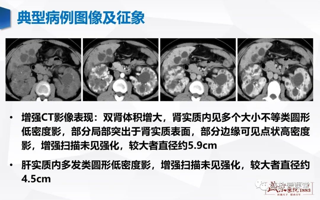 影像PPT - 【PPT】肾脏囊性病变-16 影像PPT - 【PPT】肾脏囊性病变-16