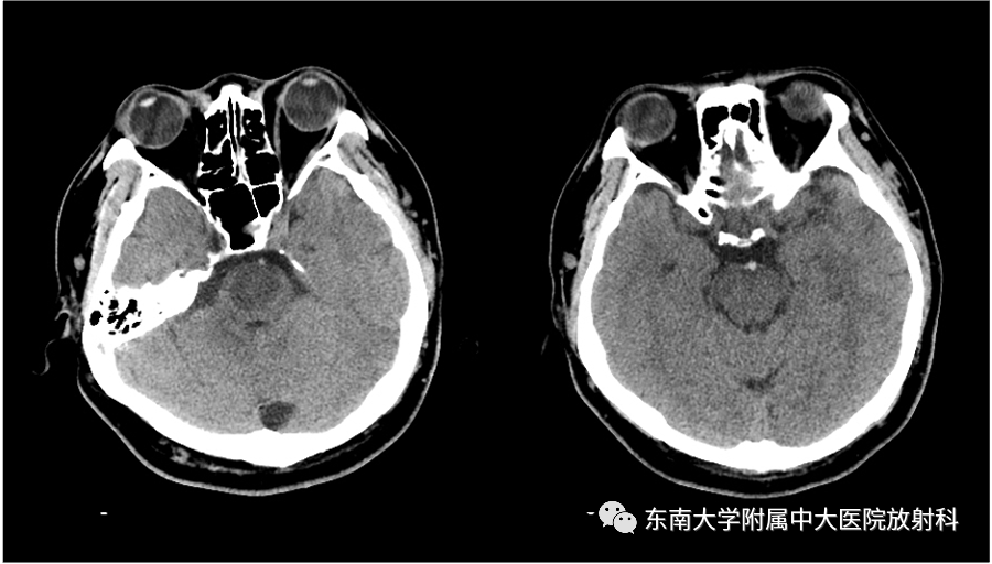 影像PPT - 【PPT】基底动脉尖综合征-2 影像PPT - 【PPT】基底动脉尖综合征-2