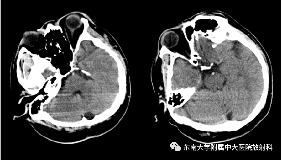影像PPT - 【PPT】基底动脉尖综合征-1 影像PPT - 【PPT】基底动脉尖综合征-1