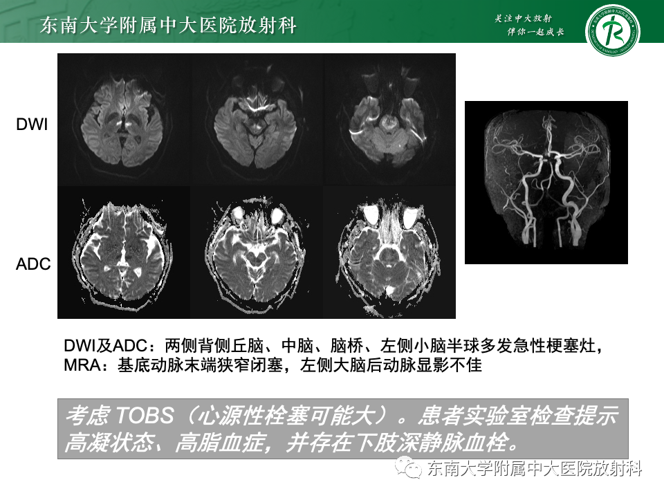 影像PPT - 【PPT】基底动脉尖综合征-7 影像PPT - 【PPT】基底动脉尖综合征-7