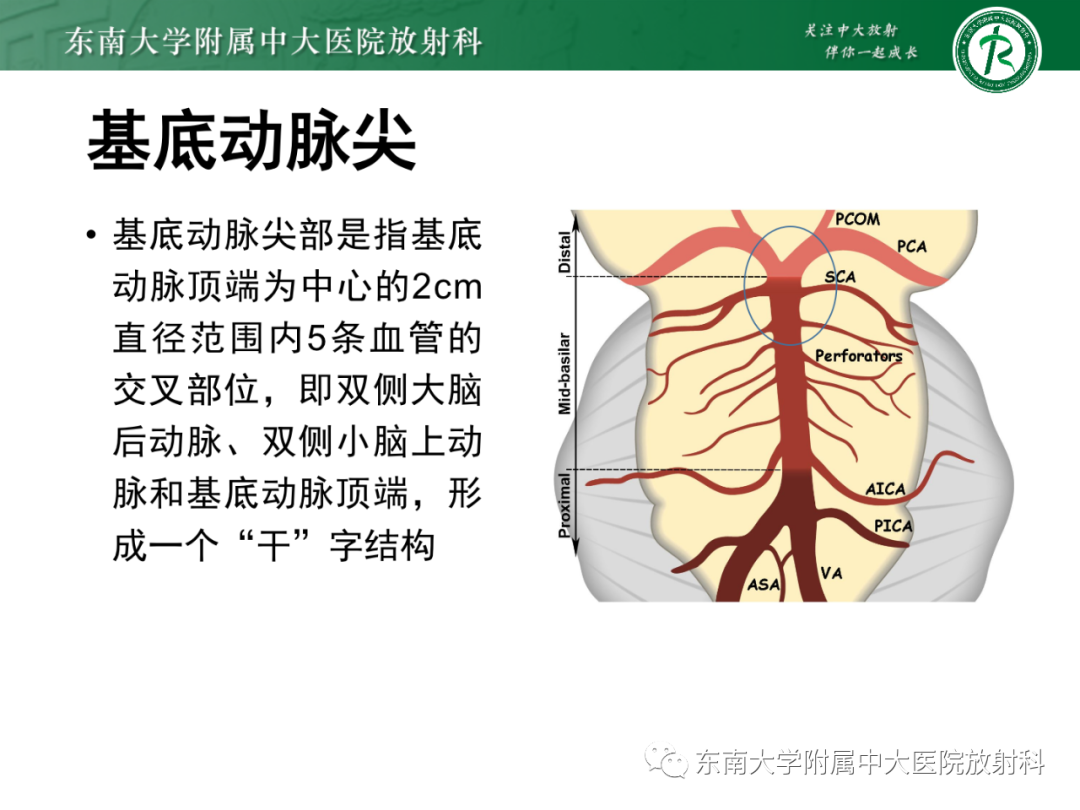 影像PPT - 【PPT】基底动脉尖综合征-12 影像PPT - 【PPT】基底动脉尖综合征-12