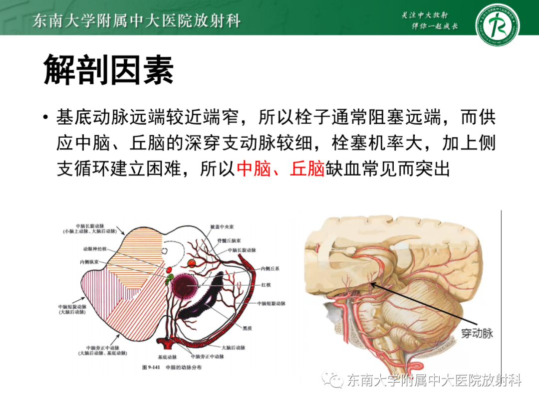影像PPT - 【PPT】基底动脉尖综合征-13 影像PPT - 【PPT】基底动脉尖综合征-13