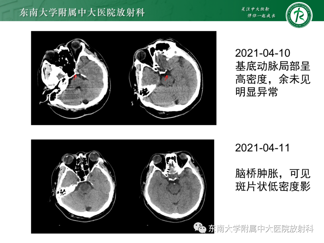 影像PPT - 【PPT】基底动脉尖综合征-6 影像PPT - 【PPT】基底动脉尖综合征-6