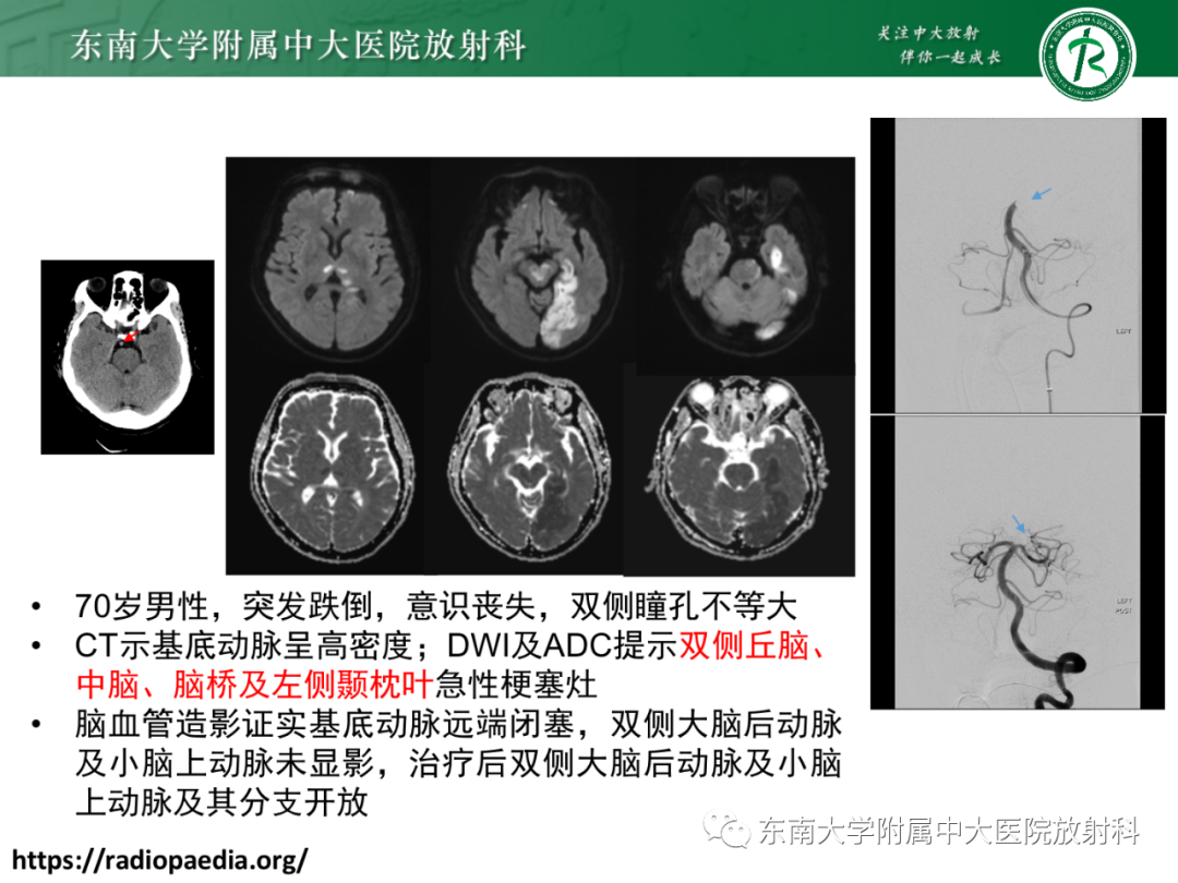 影像PPT - 【PPT】基底动脉尖综合征-18 影像PPT - 【PPT】基底动脉尖综合征-18