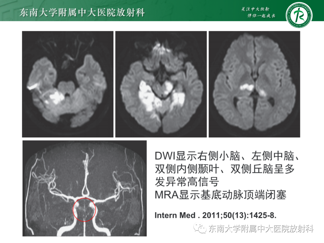 影像PPT - 【PPT】基底动脉尖综合征-19 影像PPT - 【PPT】基底动脉尖综合征-19