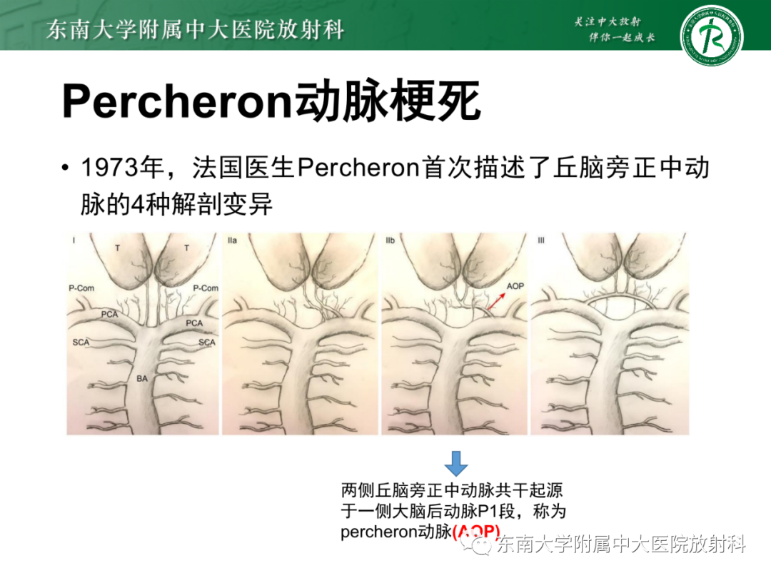 影像PPT - 【PPT】基底动脉尖综合征-21 影像PPT - 【PPT】基底动脉尖综合征-21