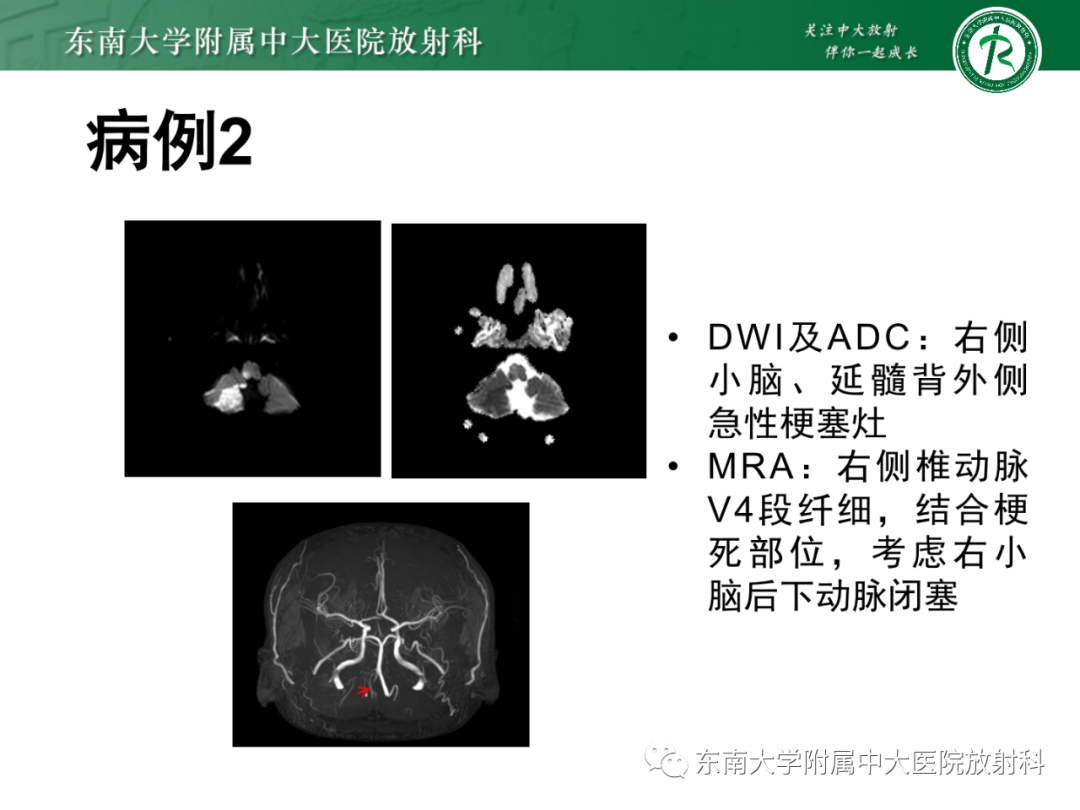 影像PPT - 【PPT】基底动脉尖综合征-28 影像PPT - 【PPT】基底动脉尖综合征-28