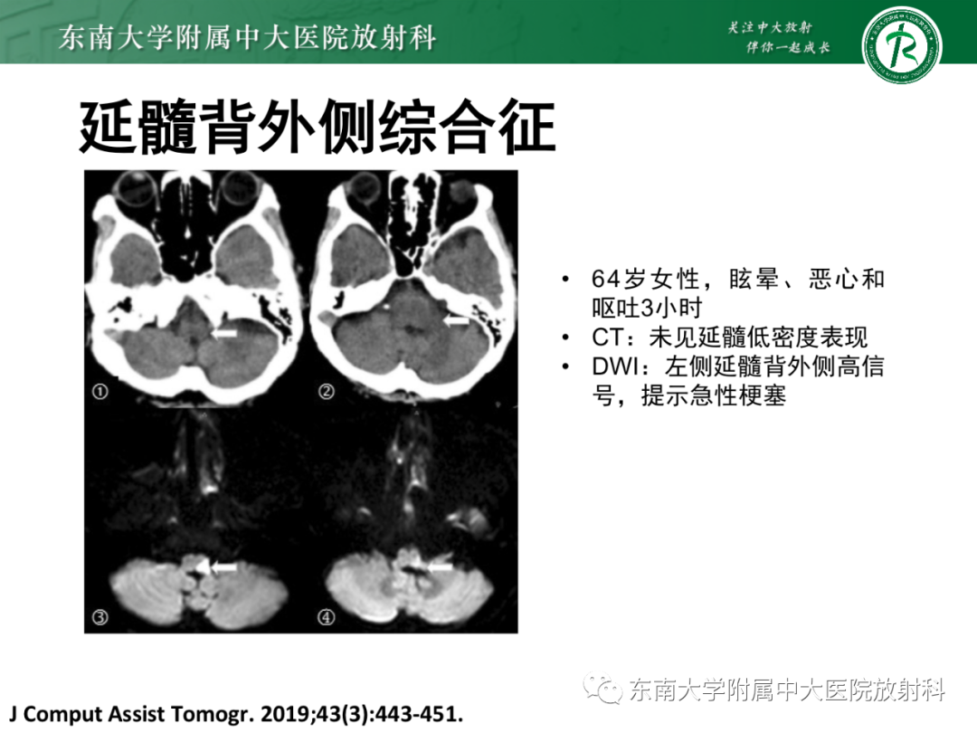 影像PPT - 【PPT】基底动脉尖综合征-29 影像PPT - 【PPT】基底动脉尖综合征-29