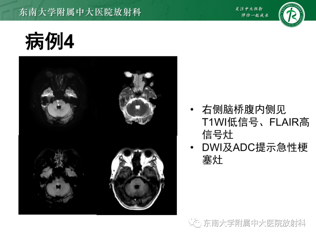 影像PPT - 【PPT】基底动脉尖综合征-34 影像PPT - 【PPT】基底动脉尖综合征-34