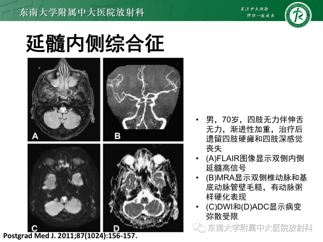 影像PPT - 【PPT】基底动脉尖综合征-31 影像PPT - 【PPT】基底动脉尖综合征-31