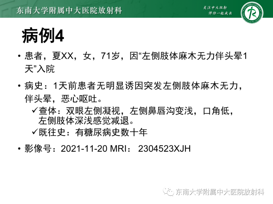 影像PPT - 【PPT】基底动脉尖综合征-33 影像PPT - 【PPT】基底动脉尖综合征-33