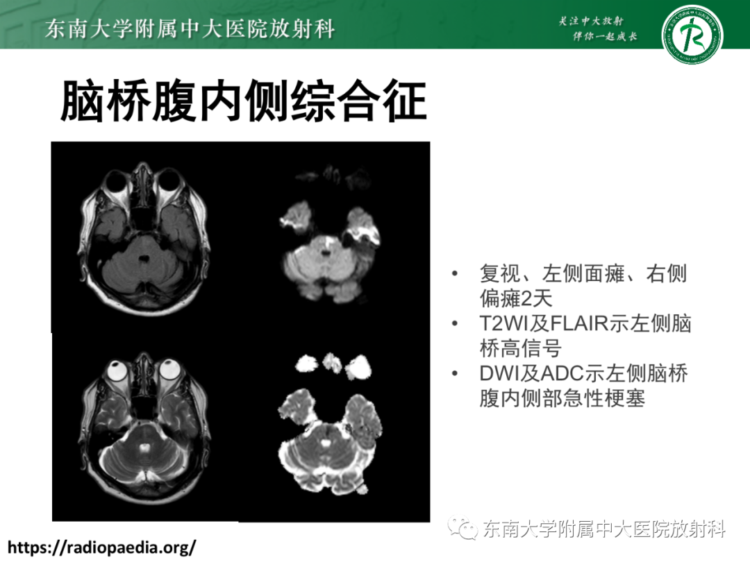 影像PPT - 【PPT】基底动脉尖综合征-35 影像PPT - 【PPT】基底动脉尖综合征-35