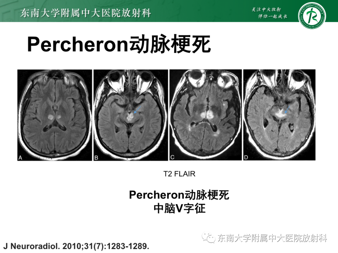 影像PPT - 【PPT】基底动脉尖综合征-23 影像PPT - 【PPT】基底动脉尖综合征-23