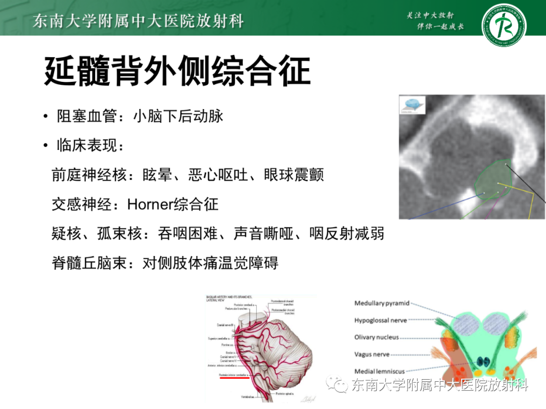 影像PPT - 【PPT】基底动脉尖综合征-26 影像PPT - 【PPT】基底动脉尖综合征-26