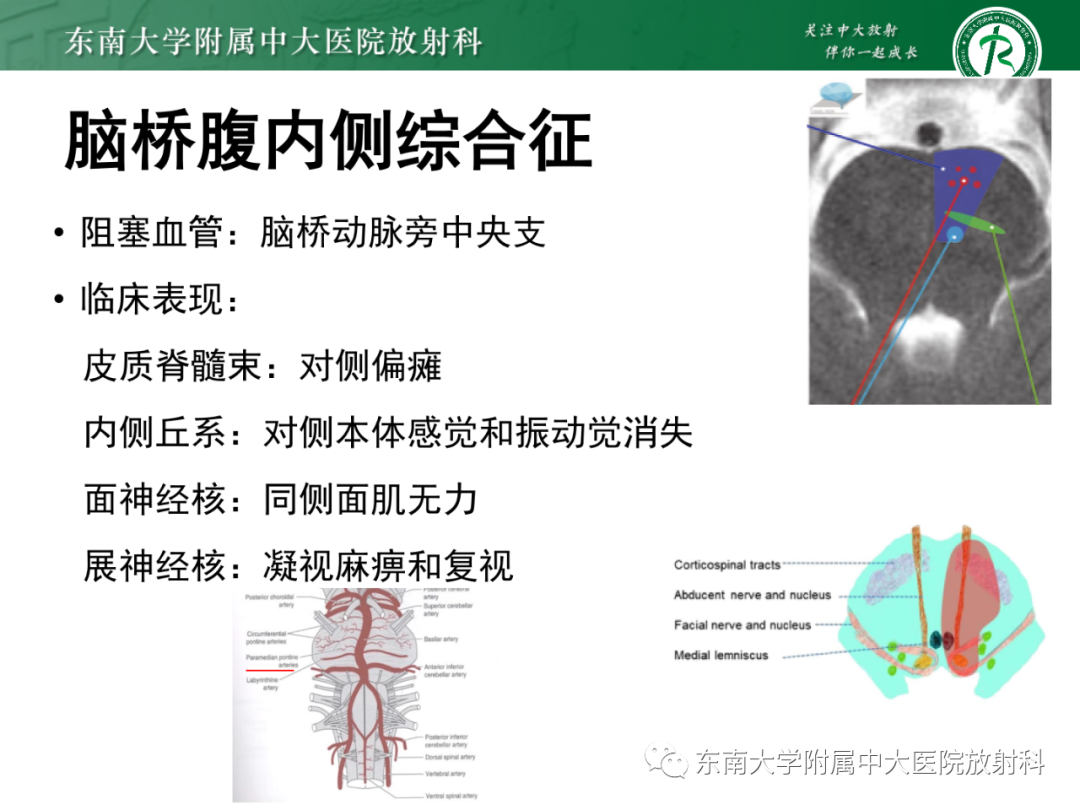 影像PPT - 【PPT】基底动脉尖综合征-32 影像PPT - 【PPT】基底动脉尖综合征-32