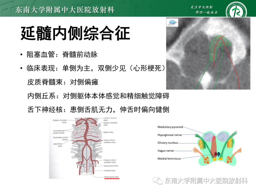 影像PPT - 【PPT】基底动脉尖综合征-30 影像PPT - 【PPT】基底动脉尖综合征-30