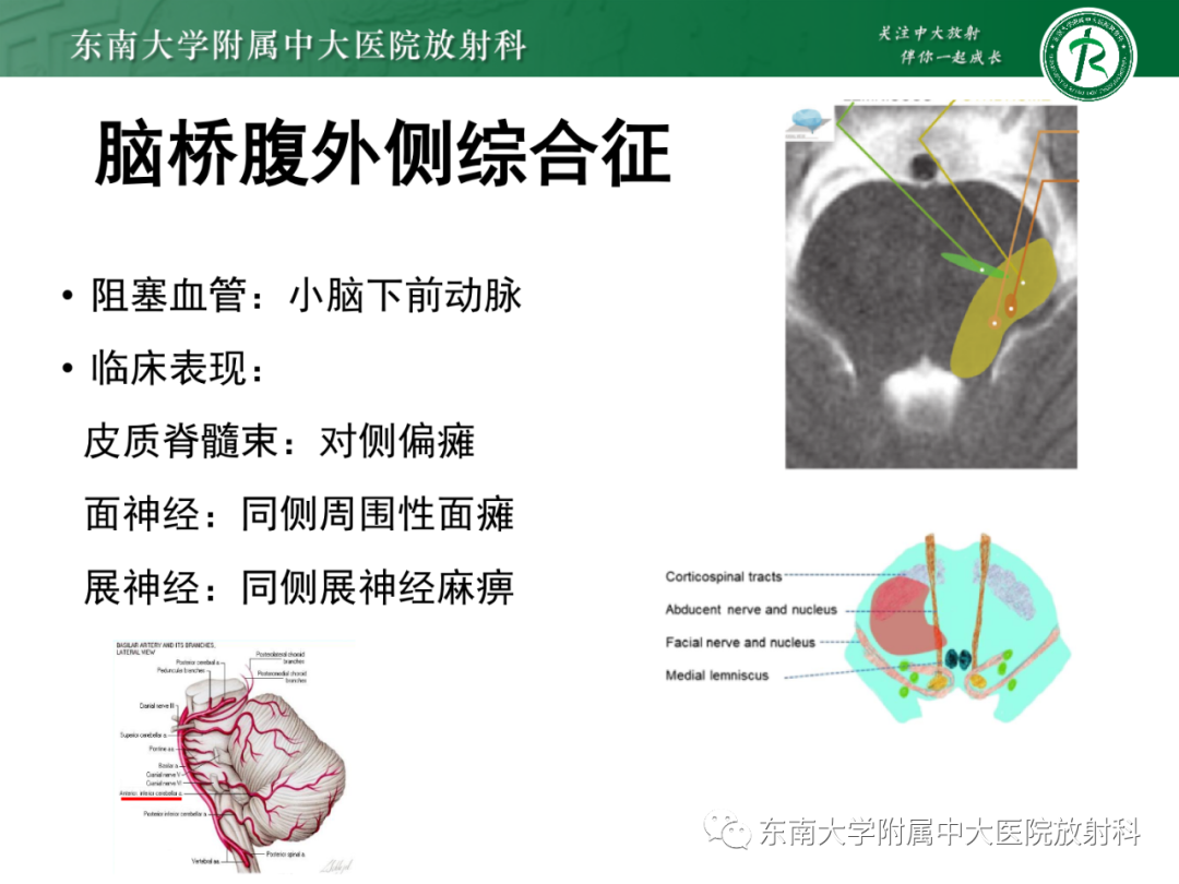 影像PPT - 【PPT】基底动脉尖综合征-36 影像PPT - 【PPT】基底动脉尖综合征-36