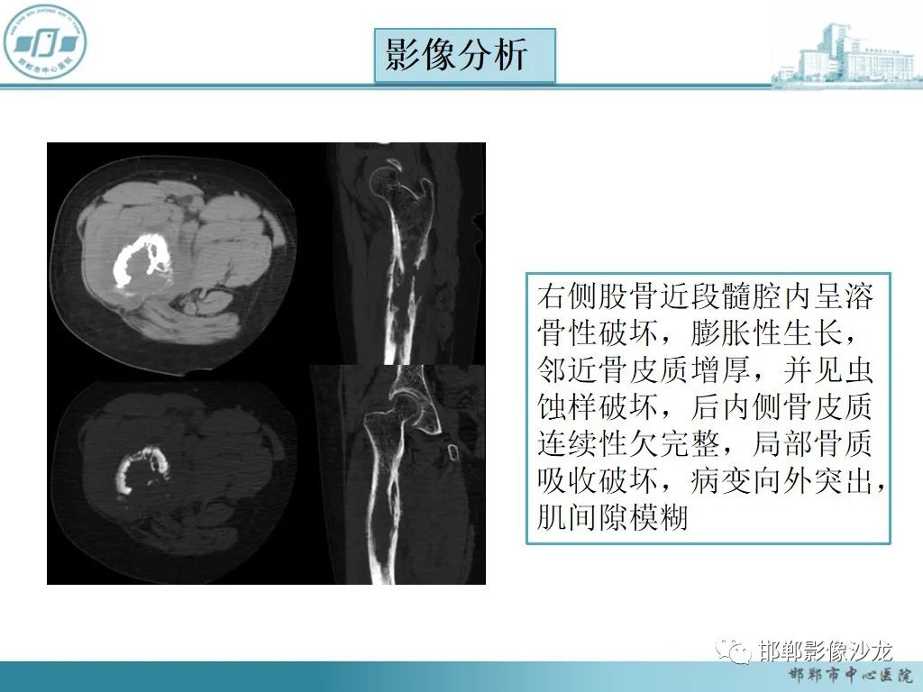 影像PPT - 【PPT】病例分析—原发性骨淋巴瘤-15 影像PPT - 【PPT】病例分析—原发性骨淋巴瘤-15