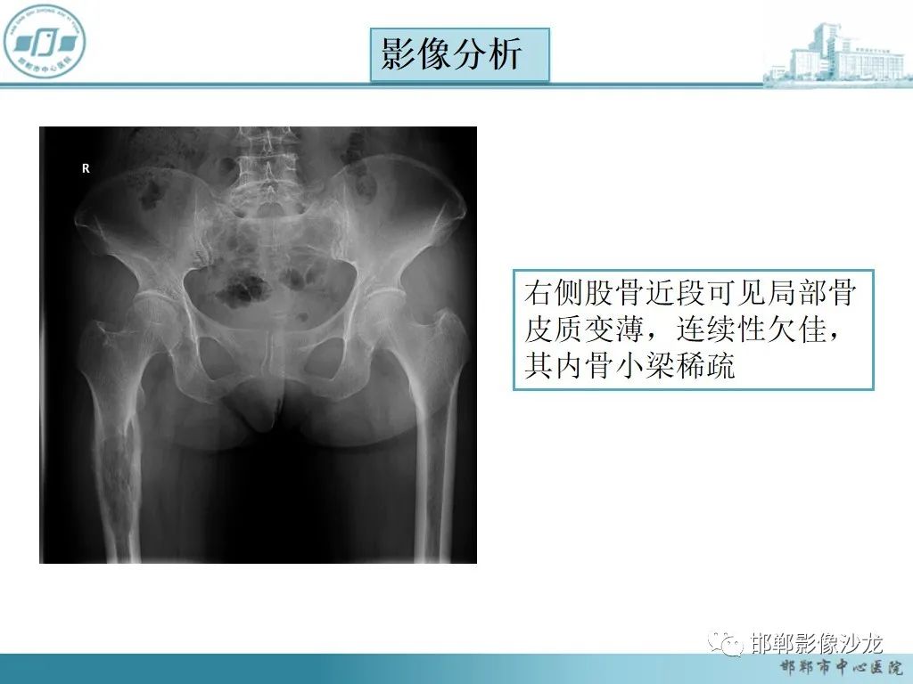 影像PPT - 【PPT】病例分析—原发性骨淋巴瘤-14 影像PPT - 【PPT】病例分析—原发性骨淋巴瘤-14