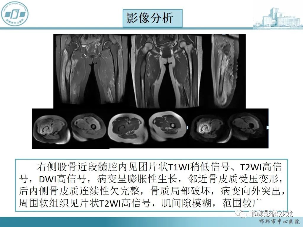 影像PPT - 【PPT】病例分析—原发性骨淋巴瘤-16 影像PPT - 【PPT】病例分析—原发性骨淋巴瘤-16