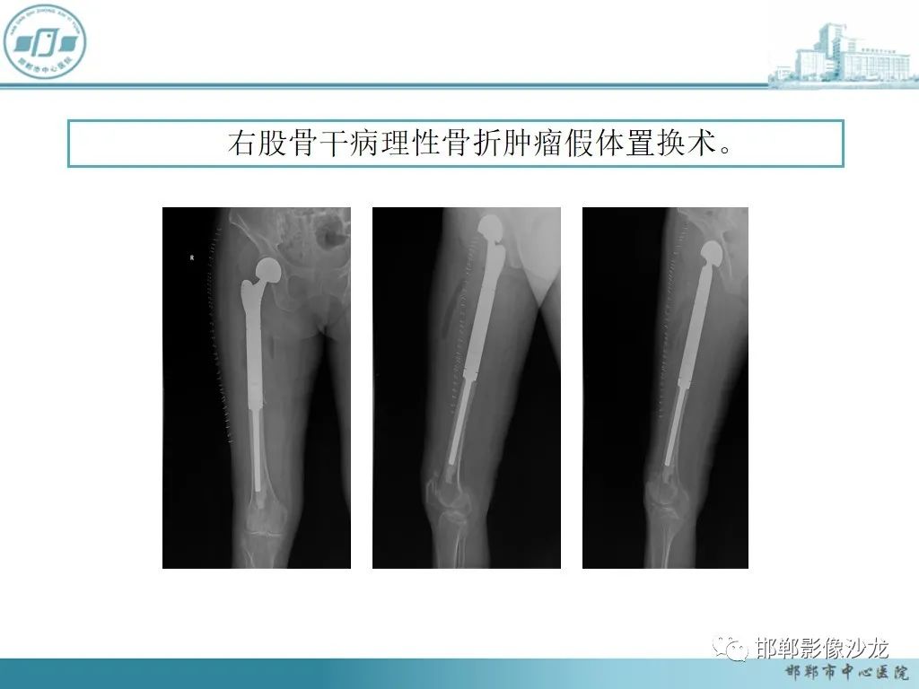 影像PPT - 【PPT】病例分析—原发性骨淋巴瘤-20 影像PPT - 【PPT】病例分析—原发性骨淋巴瘤-20