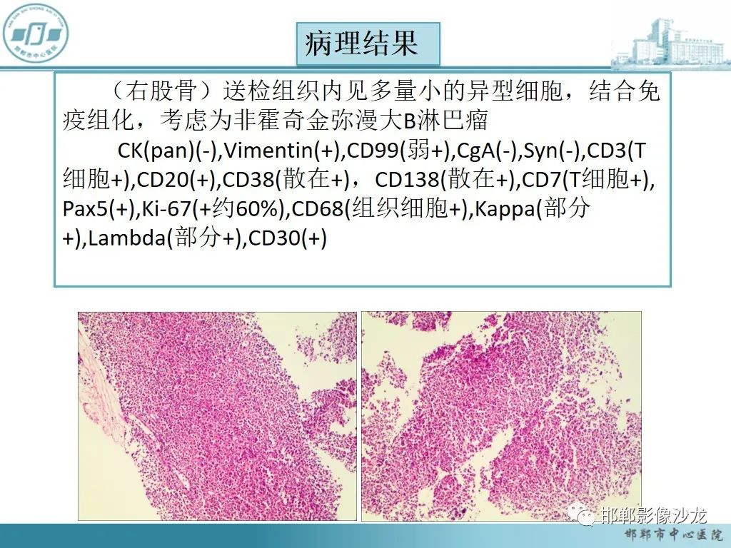 影像PPT - 【PPT】病例分析—原发性骨淋巴瘤-18 影像PPT - 【PPT】病例分析—原发性骨淋巴瘤-18