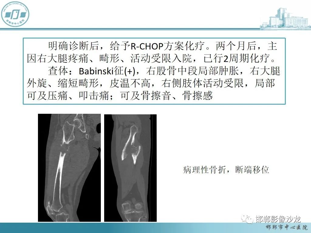 影像PPT - 【PPT】病例分析—原发性骨淋巴瘤-19 影像PPT - 【PPT】病例分析—原发性骨淋巴瘤-19