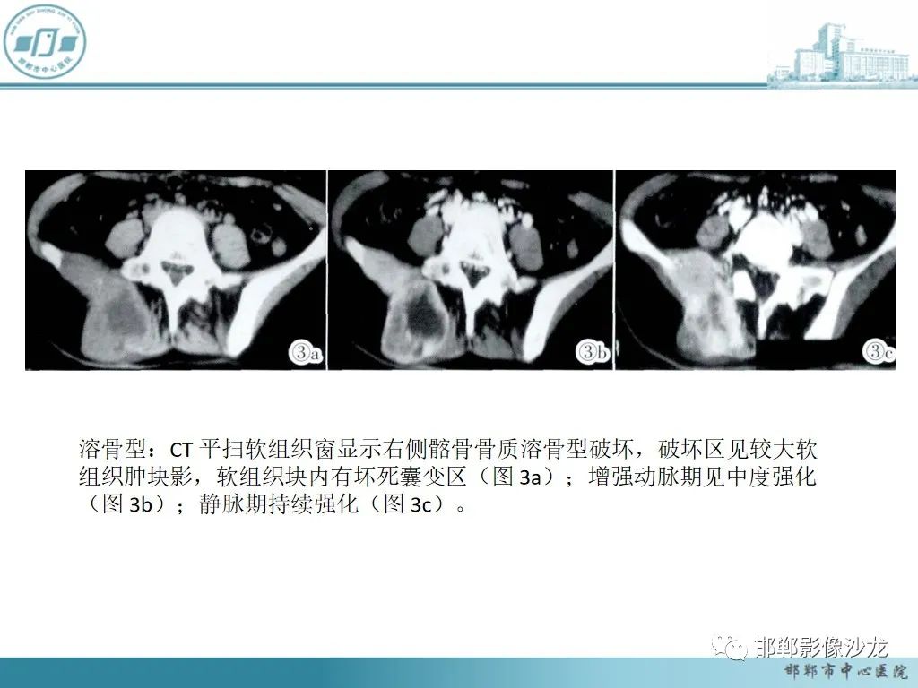 影像PPT - 【PPT】病例分析—原发性骨淋巴瘤-28 影像PPT - 【PPT】病例分析—原发性骨淋巴瘤-28