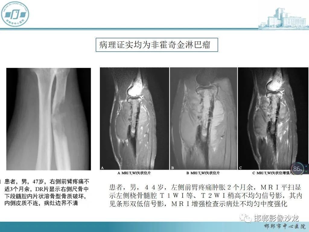 影像PPT - 【PPT】病例分析—原发性骨淋巴瘤-26 影像PPT - 【PPT】病例分析—原发性骨淋巴瘤-26