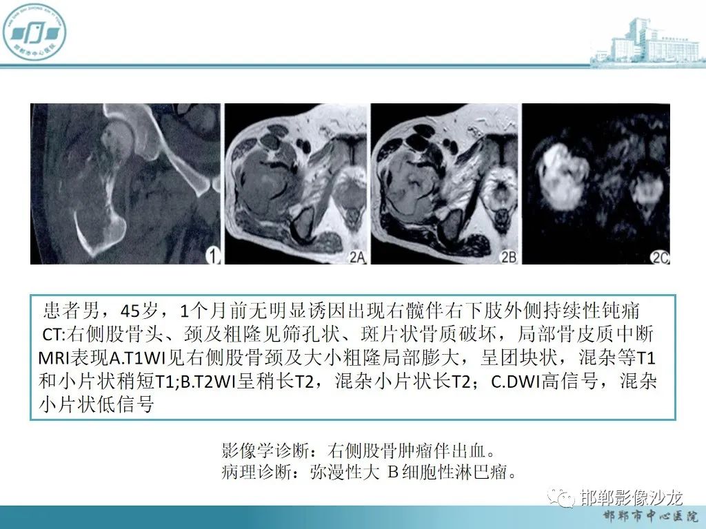 影像PPT - 【PPT】病例分析—原发性骨淋巴瘤-25 影像PPT - 【PPT】病例分析—原发性骨淋巴瘤-25