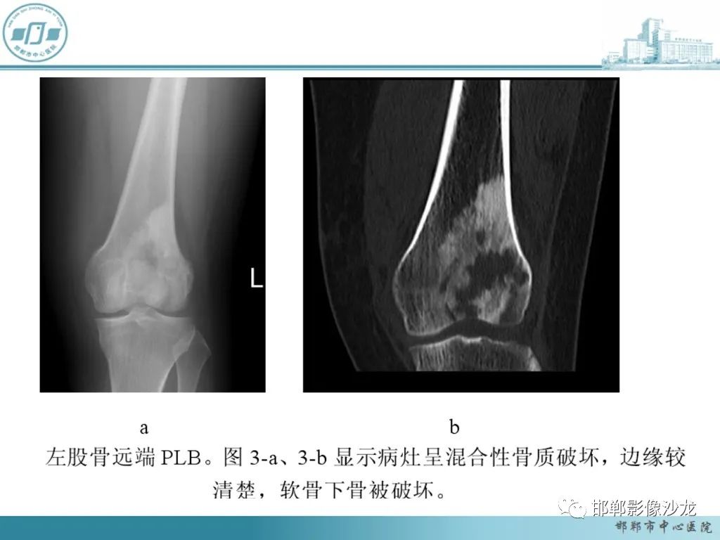 影像PPT - 【PPT】病例分析—原发性骨淋巴瘤-29 影像PPT - 【PPT】病例分析—原发性骨淋巴瘤-29